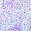 5C1 Inflammatory Demyelination (Case 5) LFB-PAS 2