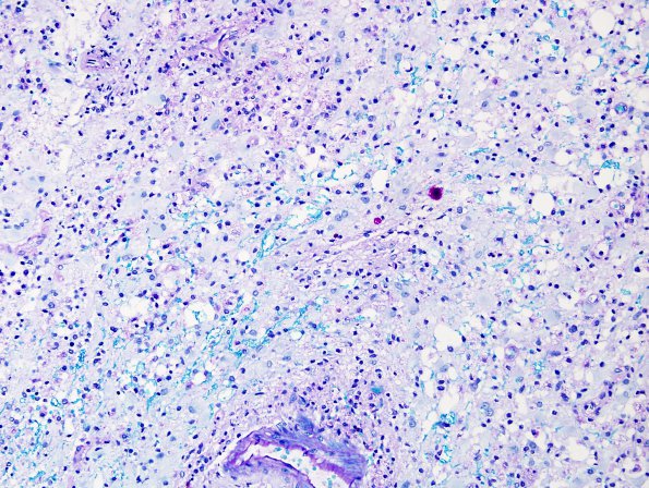 5C1 Inflammatory Demyelination (Case 5) LFB-PAS 2