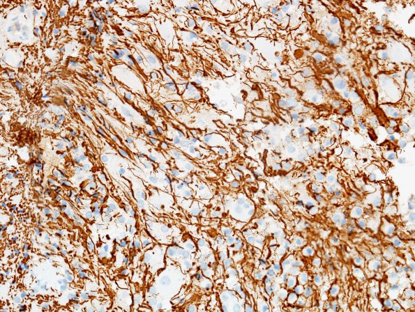 5D2 Inflammatory Demyelination (Case 5) NF 4