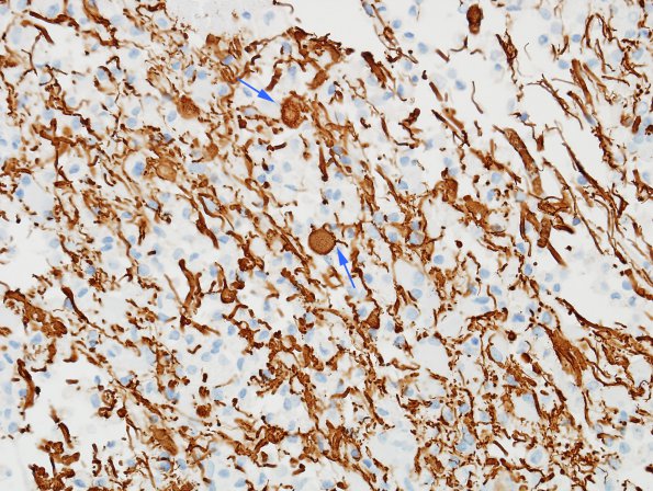 5D3 Inflammatory Demyelination (Case 5) NF 2 copy