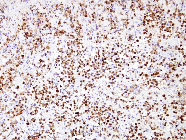 5E1 Inflammatory Demyelination (Case 5) CD68 3