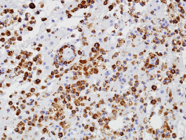 5E2 Inflammatory Demyelination (Case 5) CD68 1