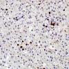 5F Inflammatory Demyelination (Case 5) CD3 2 (2)