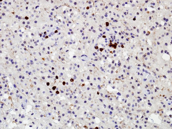 5F Inflammatory Demyelination (Case 5) CD3 2 (2)