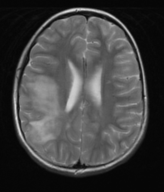 6A4 ADEM (Case 6) T2 no contrast 1