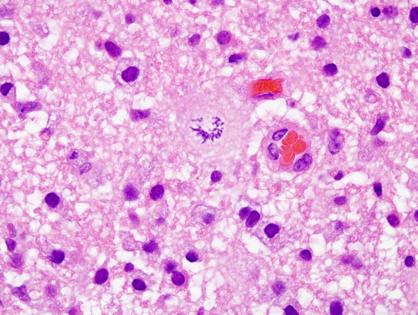 6B4 ADEM-MS (Case 6) Creutzfeldt cells H&E 3