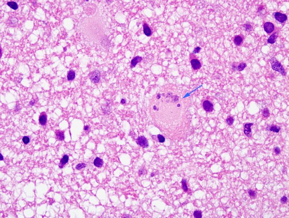 6B5 ADEM-MS (Case 6) Creutzfeldt cells H&E 4 copy