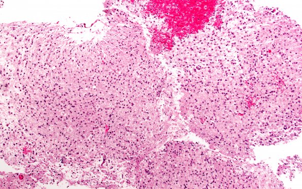 7A1 Inflammatory Demyelination (Case 7) H&E 4