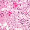 7A2 Inflammatory Demyelination (Case 7) H&E 1