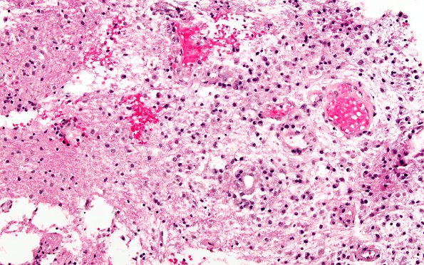 7A2 Inflammatory Demyelination (Case 7) H&E 1