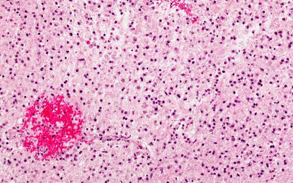 7A3 Inflammatory Demyelination (Case 7) H&E 2