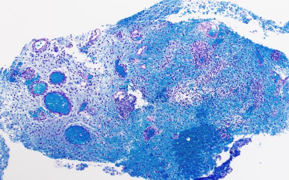 7B1 Inflammatory Demyelination (Case 7) LFB-PAS 1