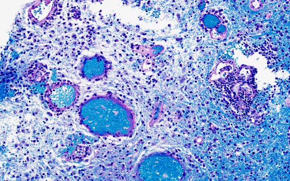7B2 Inflammatory Demyelination (Case 7) LFB-PAS 2