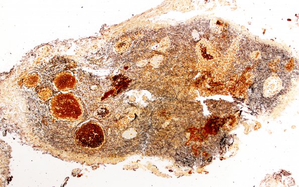 7C1 Inflammatory Demyelination (Case 7) Biels 4