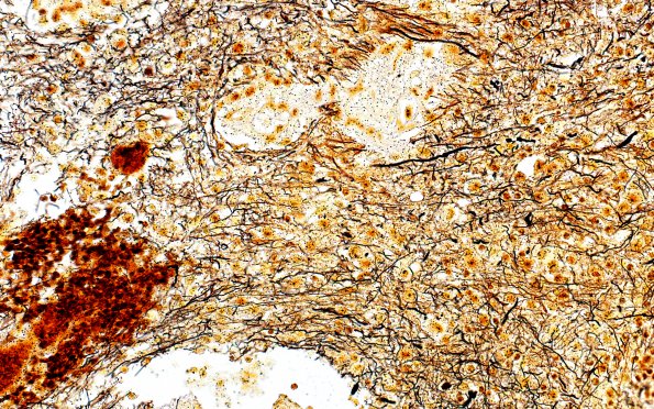 7C2 Inflammatory Demyelination (Case 7) Biels 1