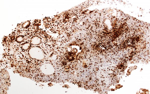 7D Inflammatory Demyelination (Case 7) CD68 2