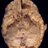 7E1 Multiple sclerosis, acute vs ADEM (Case 7) 3