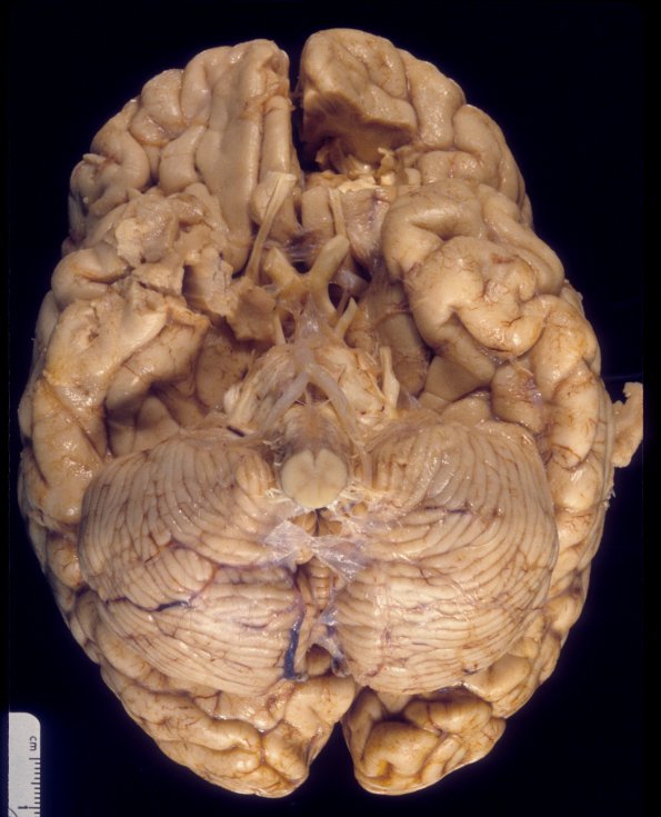 7E1 Multiple sclerosis, acute vs ADEM (Case 7) 3