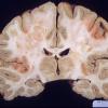 7E2 Multiple sclerosis, acute vs ADEM (Case 7) 4