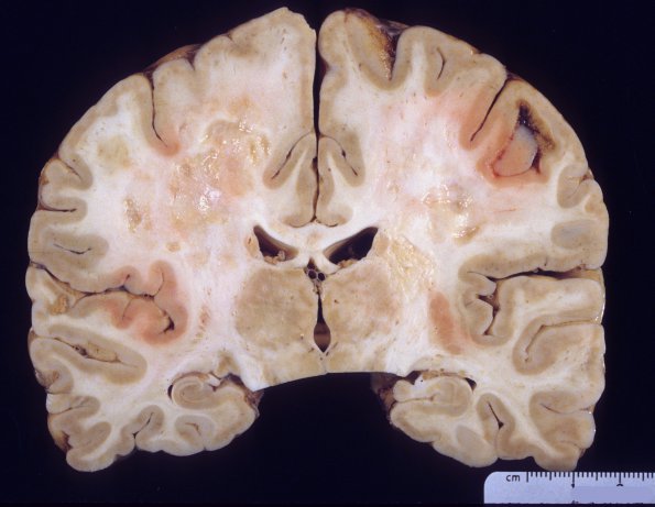 7E2 Multiple sclerosis, acute vs ADEM (Case 7) 4