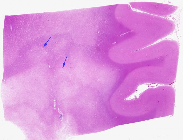 7F1 Multiple sclerosis, acute vs ADEM (Case 7)  1 H&E whole mount copy