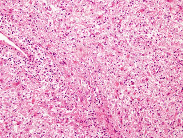 7F2 Multiple sclerosis, acute vs ADEM (Case 7) H&E 1