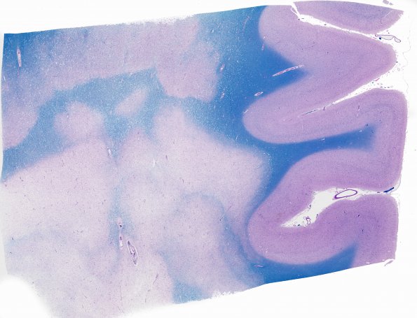 7G1 Multiple sclerosis, acute vs ADEM (Case 7) 1 LFB-PAS whole mount