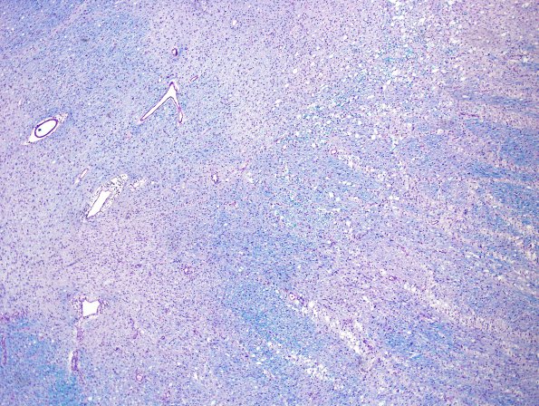 7G2 Multiple sclerosis, acute vs ADEM (Case 7) LFB-PAS 1 Match A