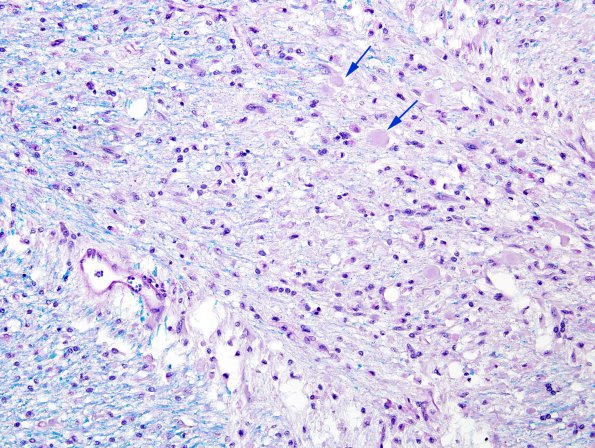 7G3 Multiple sclerosis, acute vs ADEM (Case 7) LFB-PAS 1 Match C copy