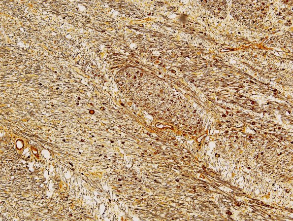 7H3 Multiple sclerosis, acute vs ADEM (Case 7) Biels 1 Match B