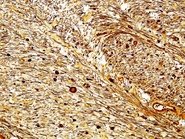 7H4 Multiple sclerosis, acute vs ADEM (Case 7) Biels 1 Match C