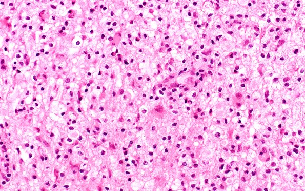 8A1 Inflammatory demyelination (Case 8) H&E 1