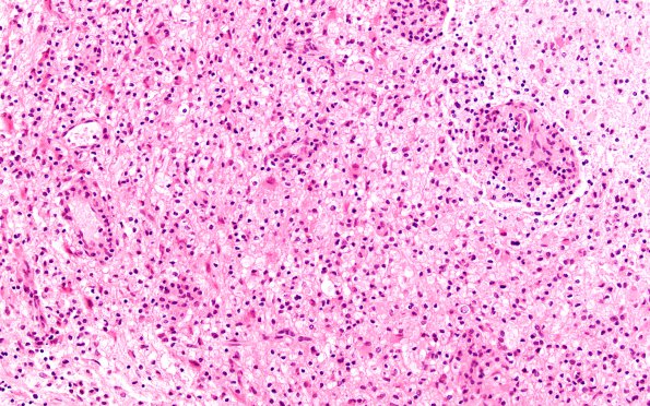 8A2 Inflammatory demyelination (Case 8) H&E 2 high contrast