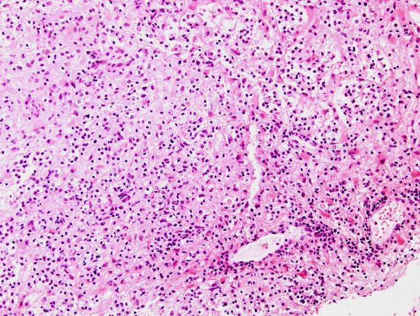 8A3 Multiple sclerosis, Acute MS (Case 8) H&E 20X