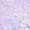 8B1 Inflammatory demyelination (Case 8) LFB-PAS 3