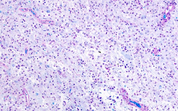 8B1 Inflammatory demyelination (Case 8) LFB-PAS 3