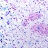 8B2 Inflammatory demyelination (Case 8) LFB-PAS 1 copy