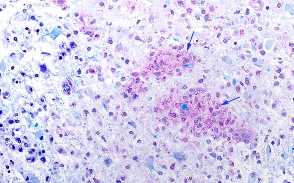 8B2 Inflammatory demyelination (Case 8) LFB-PAS 1 copy