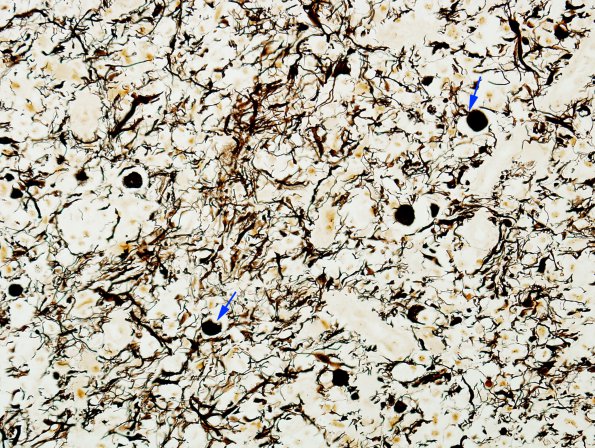 8C Multiple sclerosis, Acute (Case 8) Biels 40X copy