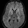 9A1 Inflammatory demyelination (fulminant ADEM, Case 9) FLAIR 2