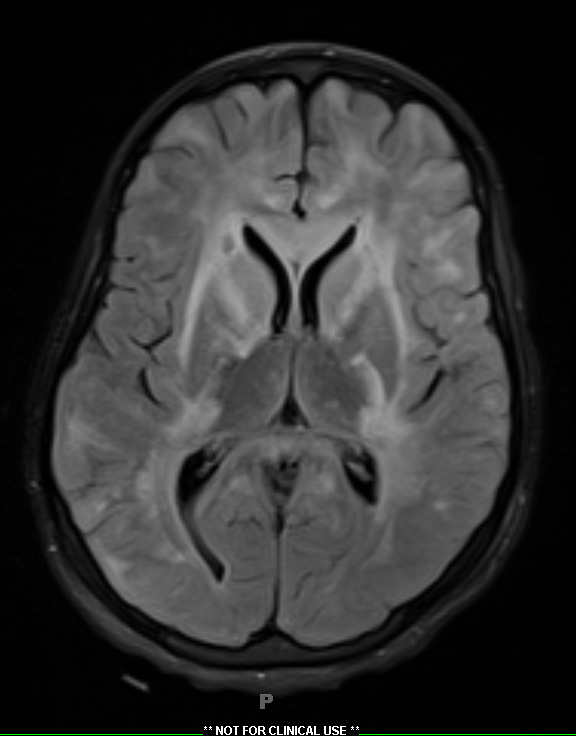 9A1 Inflammatory demyelination (fulminant ADEM, Case 9) FLAIR 2