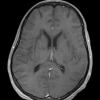 9A2 Inflammatory demyelination (fulminant ADEM, Case 9) T1 with contrast