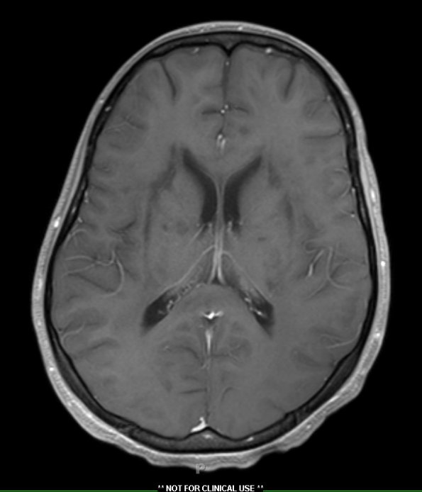 9A2 Inflammatory demyelination (fulminant ADEM, Case 9) T1 with contrast