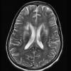 9A3 Inflammatory demyelination (fulminant ADEM, Case 9) T2 without contrast