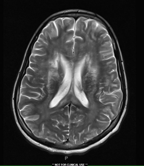 9A3 Inflammatory demyelination (fulminant ADEM, Case 9) T2 without contrast