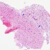 9B1 ADEM, prominent axonal degeneration (fulminant ADEM, Case 9) H&E 10X copy