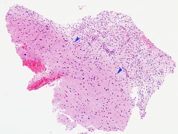 9B1 ADEM, prominent axonal degeneration (fulminant ADEM, Case 9) H&E 10X copy