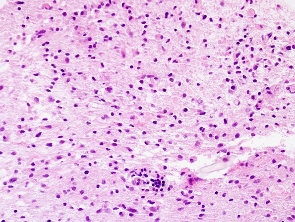 9B4 ADEM, prominent axonal degeneration (fulminant ADEM, Case 9) H&E 40X 1