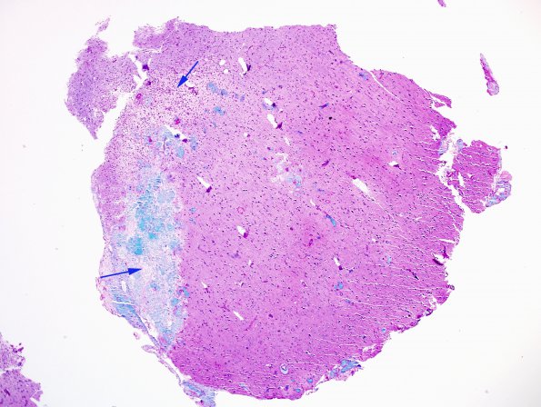 9C1 ADEM, prominent axonal degeneration (fulminant ADEM, Case 9) LFB-PAS 10X copy.