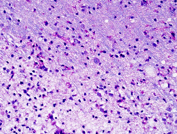 9C2 ADEM, prominent axonal degeneration (fulminant ADEM, Case 9) LFB-PAS 40X